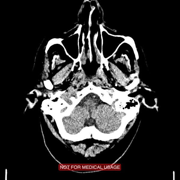 File:Artery of Percheron infarction (Radiopaedia 28679-28967 Axial non-contrast 14).jpg