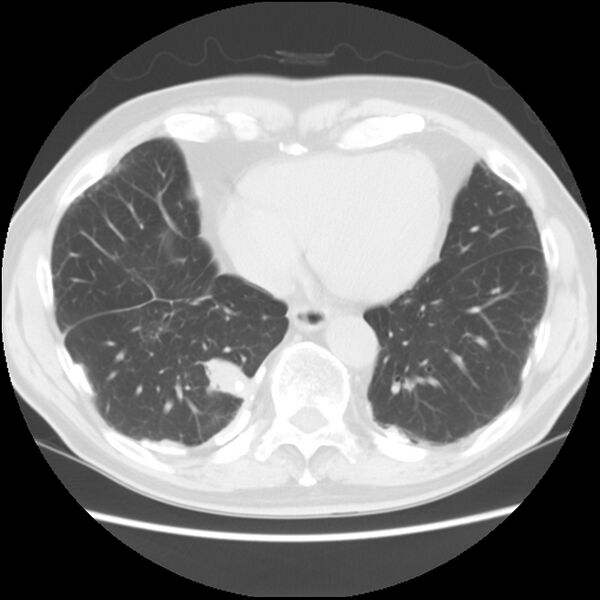 File:Asbestos-related pleural plaques (Radiopaedia 39069-41255 Axial lung window 53).jpg