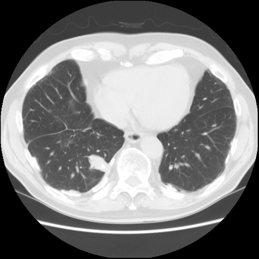 Asbestos-related pleural plaques (Radiopaedia 39069-41255 Axial lung window 53).jpg