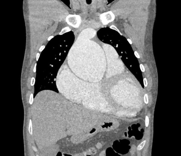 File:Ascending aortic aneurysm (Radiopaedia 86279-102297 B 18).jpg