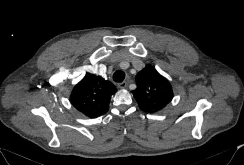 File:Ascending aortic aneurysm (Radiopaedia 86279-102297 C 7).jpg