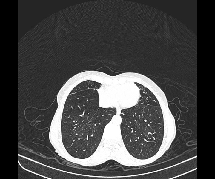 File:Aspergillomas (Radiopaedia 66779-76110 Axial lung window 35).jpg