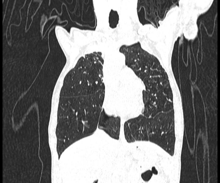 File:Aspergillomas (Radiopaedia 66779-76110 Coronal lung window 8).jpg