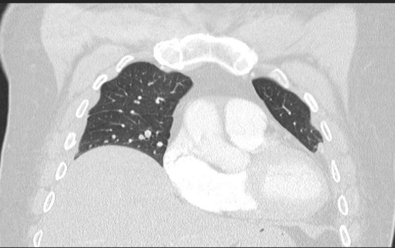 File:Aspirated tooth (Radiopaedia 28584-28844 Axial lung window 41).jpg
