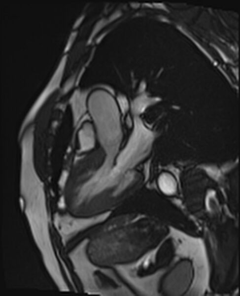 File:Asymmetric septal hypertrophic cardiomyopathy - systolic anterior motion of mitral leaflet (Radiopaedia 72795-83445 B 24).jpg