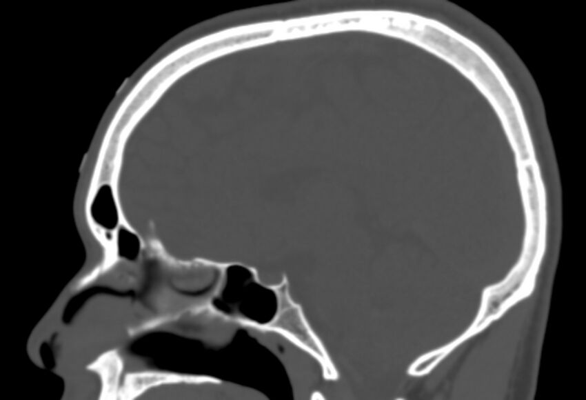 Asymptomatic occipital spur (Radiopaedia 87753-104201 Sagittal bone window 147).jpg