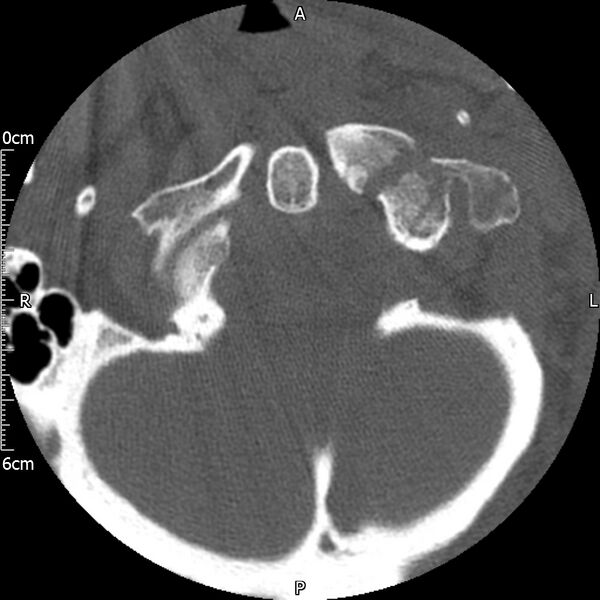 File:Atlas fracture with Currarino type A congenital defect (Radiopaedia 71747-82144 Axial bone window 30).jpg