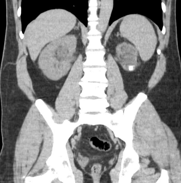 File:Atrophic kidney due to severe chronic obstructive hydronephrosis (Radiopaedia 40828-43474 Coronal non-contrast 7).jpg