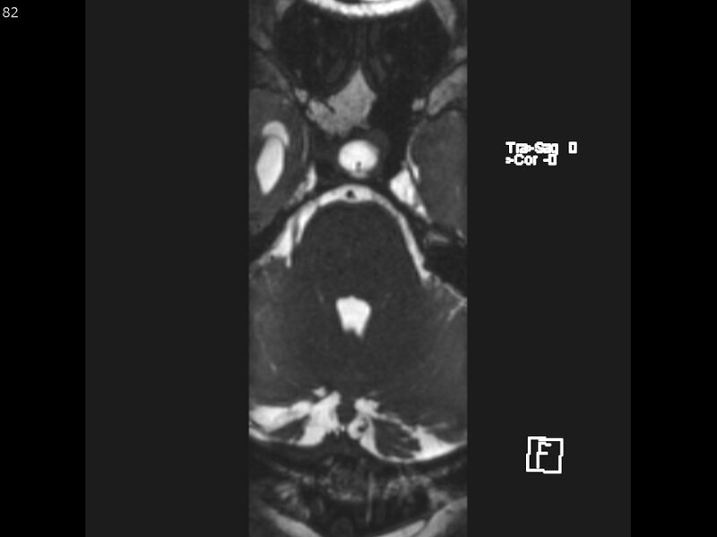 File:Atypical meningioma - intraosseous (Radiopaedia 64915-74572 Axial CISS 82).jpg