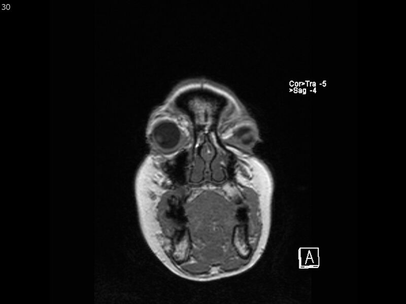 File:Atypical meningioma - intraosseous (Radiopaedia 64915-74572 Coronal T1 30).jpg