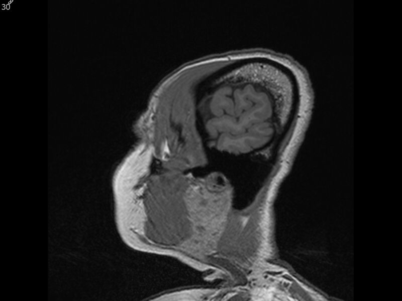 File:Atypical meningioma - intraosseous (Radiopaedia 64915-74572 Sagittal T1 30).jpg