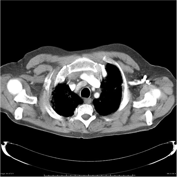 File:Atypical pneumonia - Q fever (Radiopaedia 21993-21989 C+ arterial phase 6).jpg
