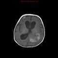 Atypical teratoid rhabdoid tumor (Radiopaedia 10712-11183 Axial T1 8).jpg