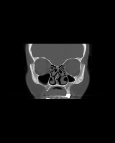 File:Automastoidectomy with labyrinthine fistula (Radiopaedia 84143-99411 Coronal non-contrast 26).jpg