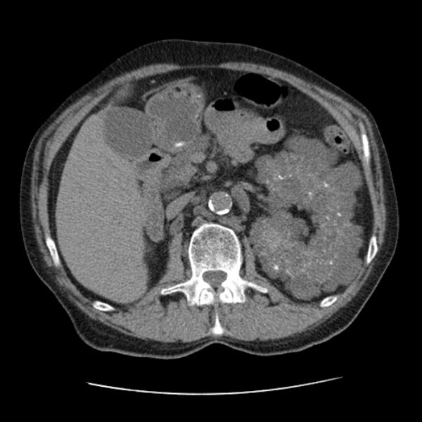 File:Autosomal dominant polycystic kidney disease (Radiopaedia 27851-28094 Axial non-contrast 66).jpg