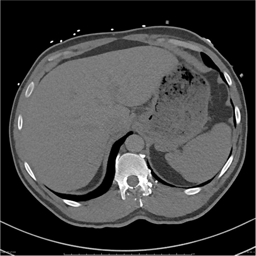 Azygos venous system anatomy (CT pulmonary angiography) (Radiopaedia 25928-26077 Axial C+ CTPA 83).jpg