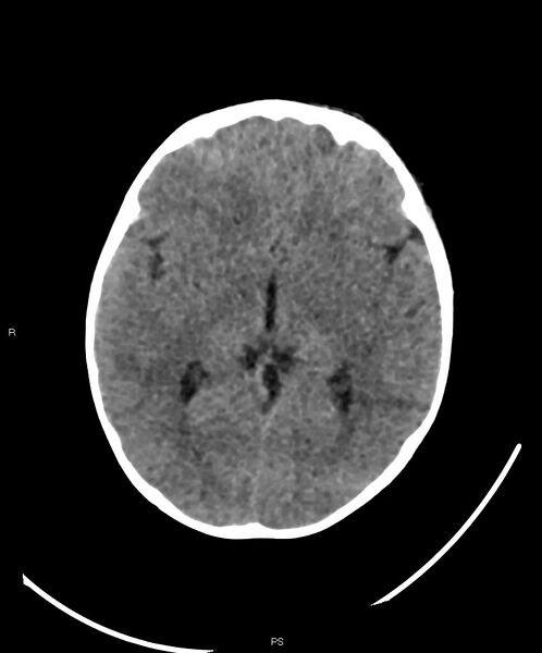 File:Basal ganglia and parenchymal ischemia (Radiopaedia 45818-50083 Axial non-contrast 24).jpg