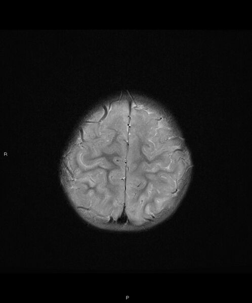 File:Basal ganglia and parenchymal ischemia (Radiopaedia 45818-50084 Axial T2 18).jpg