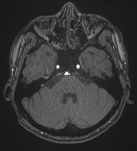 File:Basal ganglia subacute infarct (Radiopaedia 80201-93521 Axial MRA 19).png