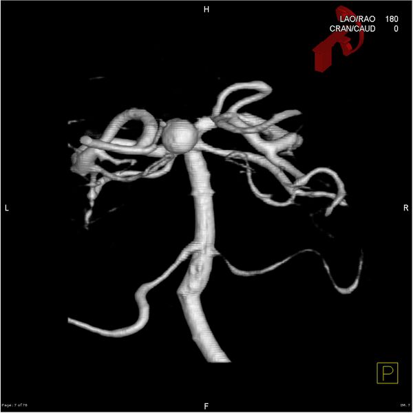 File:Basilar tip aneurysm double balloon remodeling (Radiopaedia 18100-17883 3D rotation 7).jpg