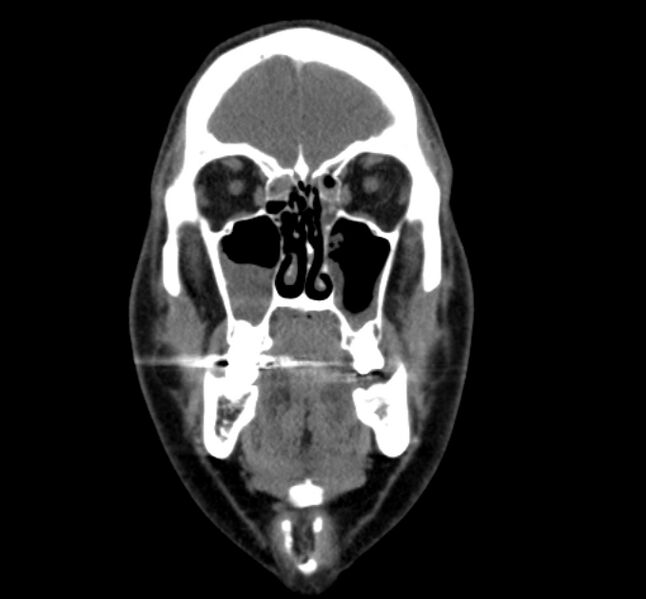 File:Benign mixed salivary tumor of the parotid gland (Radiopaedia 35261-36792 B 5).jpg