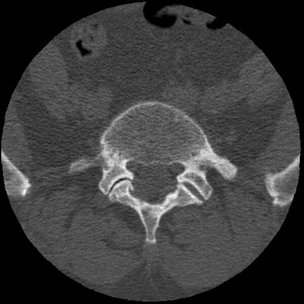 File:Bertolotti syndrome (Radiopaedia 24864-25128 Axial bone window 3).jpg