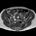 Bicornuate uterus (Radiopaedia 61974-70046 Axial T1 24).jpg