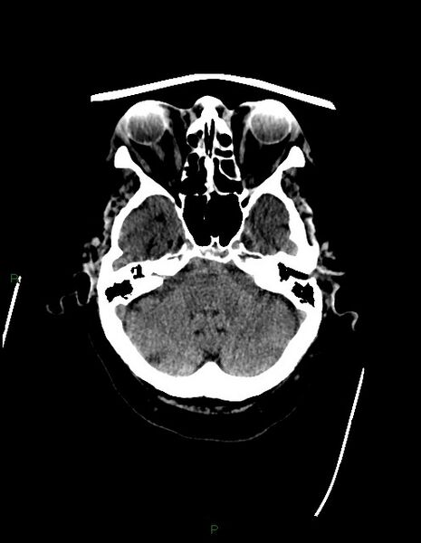 File:Bilateral acute middle cerebral artery territory infarcts (Radiopaedia 77319-89401 Axial non-contrast 19).jpg