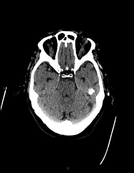 File:Bilateral acute middle cerebral artery territory infarcts (Radiopaedia 77319-89401 Axial non-contrast 28).jpg