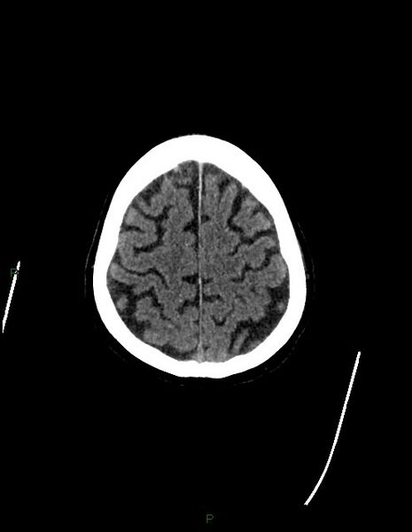 File:Bilateral acute middle cerebral artery territory infarcts (Radiopaedia 77319-89401 Axial non-contrast 75).jpg