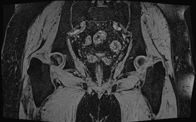 File:Bilateral avascular necrosis of femoral head (Radiopaedia 77116-89078 Coronal T2 we 17).jpg