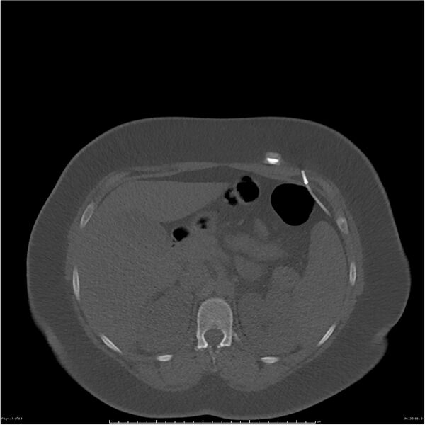 File:Bilateral lumbar ribs (Radiopaedia 25862-26010 bone window 7).jpg