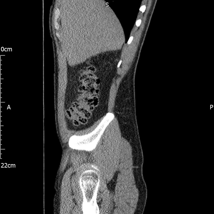 Bilateral medullary nephrocalcinosis with ureteric calculi (Radiopaedia 71269-81569 C 92).jpg