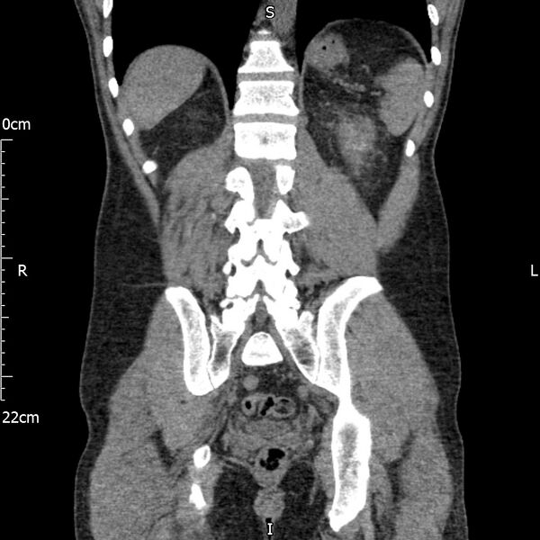 File:Bilateral medullary nephrocalcinosis with ureteric calculi (Radiopaedia 71269-81569 Coronal non-contrast 53).jpg