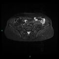 Bilateral ovarian fibroma (Radiopaedia 44568-48293 Axial STIR 2).jpg