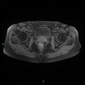 Bilateral ovarian fibroma (Radiopaedia 44568-48293 Axial T1 fat sat 22).jpg