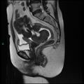 Bilateral ovarian fibroma (Radiopaedia 44568-48293 Sagittal T2 16).jpg
