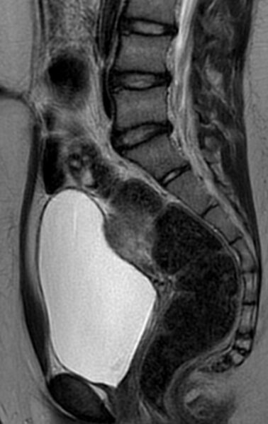 File:Bilateral ovarian fibrothecomas - adolescent (Radiopaedia 86604-102707 Sagittal T2 18).jpg