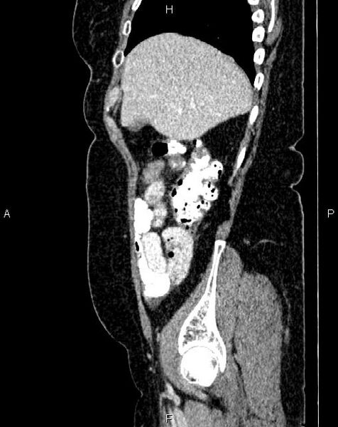 File:Bilateral ovarian serous cystadenocarcinoma (Radiopaedia 86062-101989 E 13).jpg