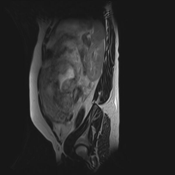 File:Bilobed placenta accreta (Radiopaedia 69648-79591 G 13).jpg