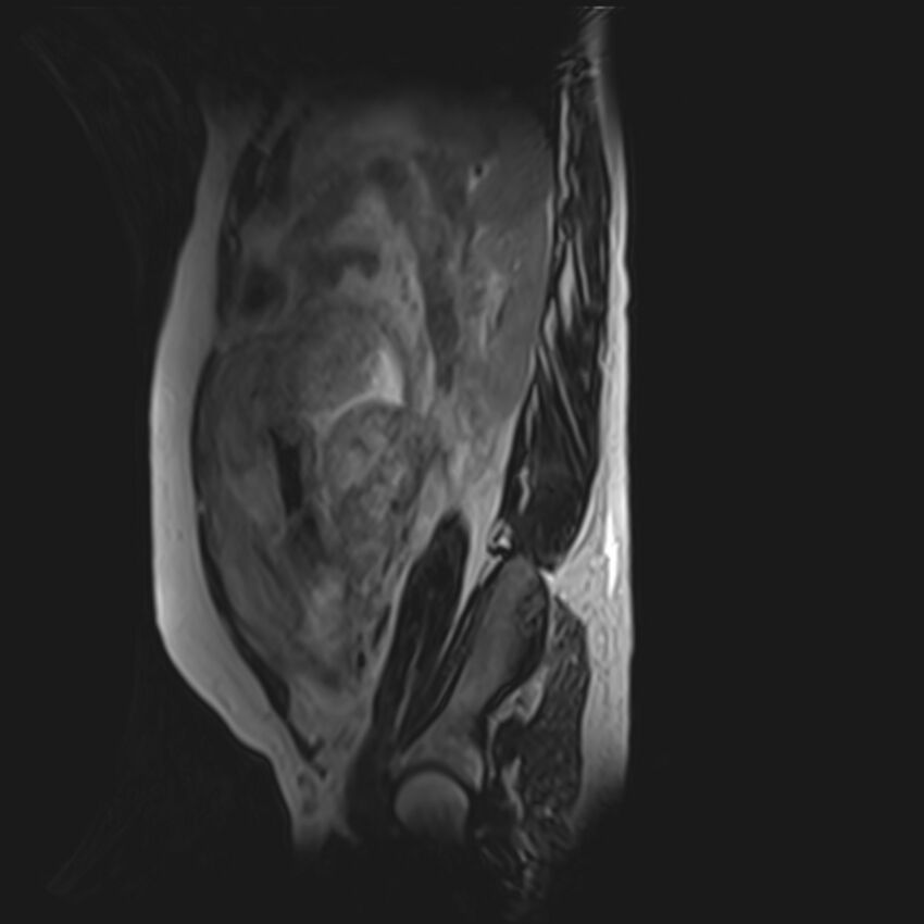 Bilobed placenta accreta (Radiopaedia 69648-79591 G 15).jpg