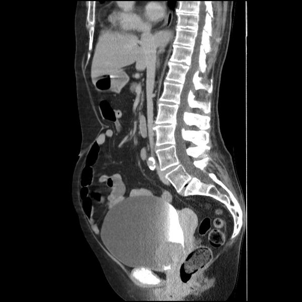 File:Bladder tumor detected on trauma CT (Radiopaedia 51809-57609 E 38).jpg