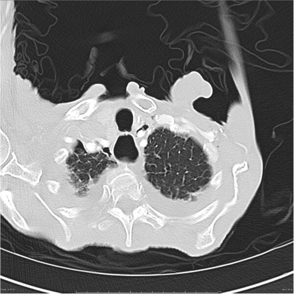 File:Boerhaave syndrome (Radiopaedia 26240-26362 Axial lung window 6).jpg