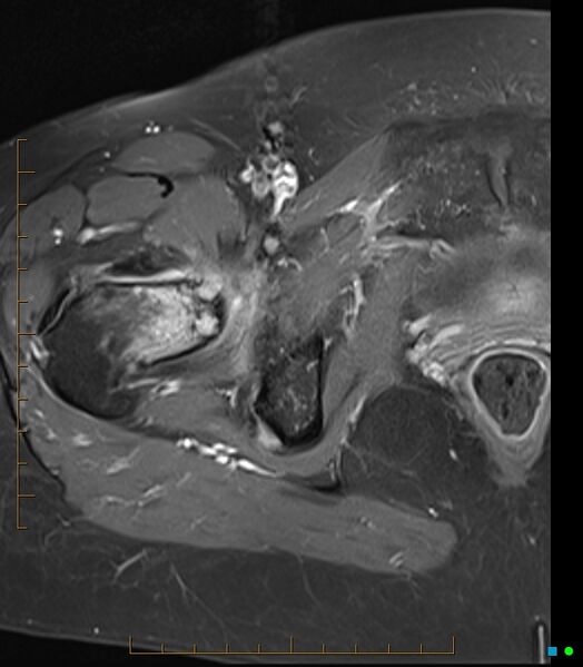 File:Bone metastasis - breast cancer (Radiopaedia 16667-16374 Axial T1 C+ fat sat 8).jpg