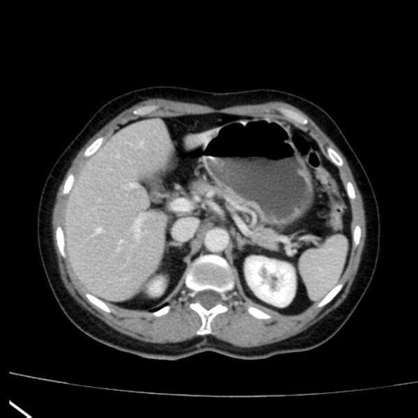 File:Bosniak renal cyst - type I (Radiopaedia 27479-27675 C 22).jpg