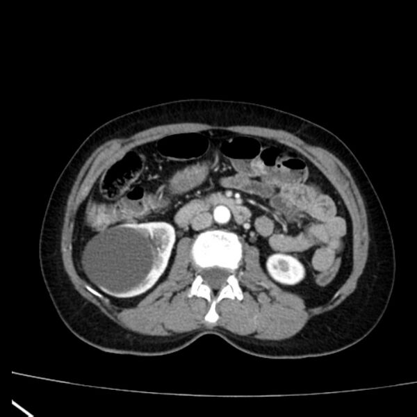 File:Bosniak renal cyst - type I (Radiopaedia 27479-27675 renal cortical phase 39).jpg