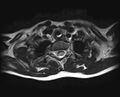 Brachial plexus birth palsy (Radiopaedia 68118-77604 Axial T2 18).jpg