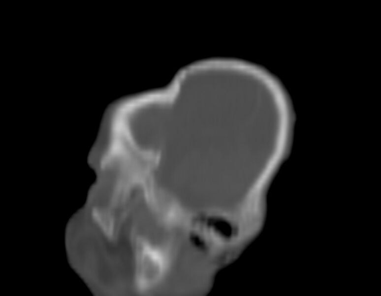 File:Brachycephaly (bi-coronal and bi-lambdoid synostosis) (Radiopaedia 55048-61413 Sagittal bone window 4).jpg