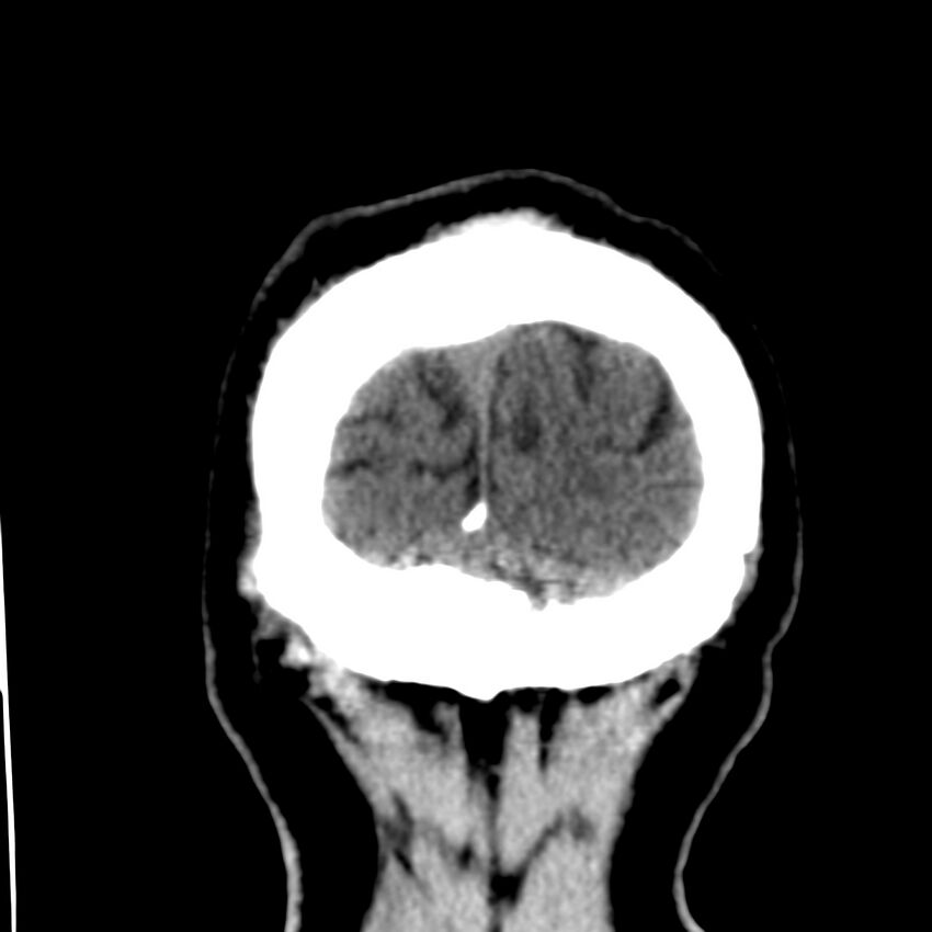 Brain Pantopaque remnants (Radiopaedia 78403-91048 Coronal non-contrast 66).jpg