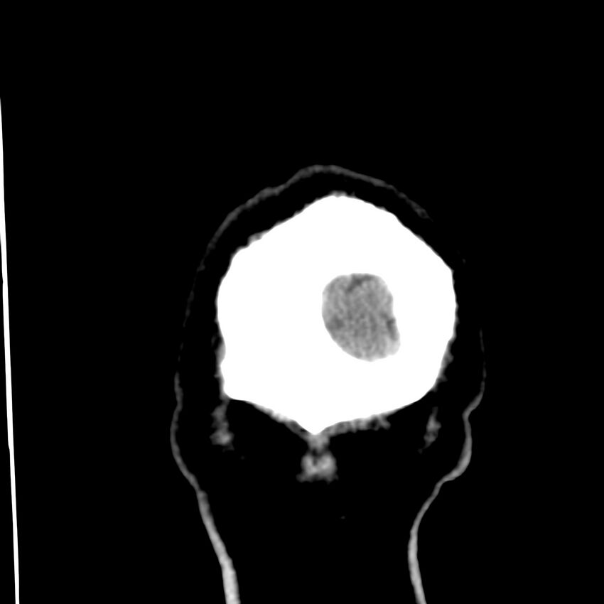Brain Pantopaque remnants (Radiopaedia 78403-91048 Coronal non-contrast 71).jpg